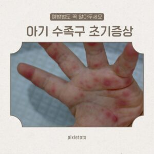 수족구 초기증상