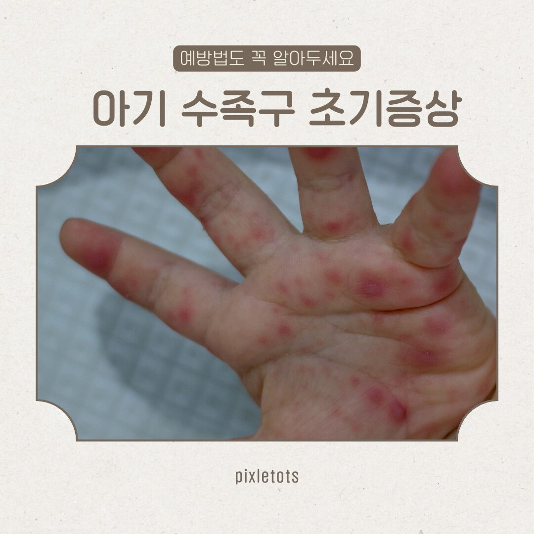 수족구 초기증상
