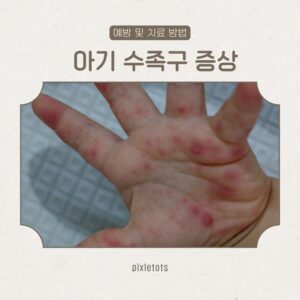 아기 수족구